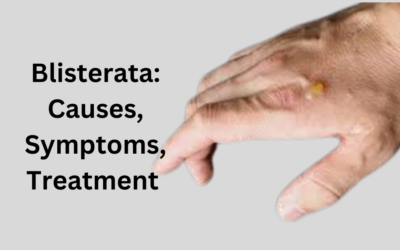 Blisterata Causes, Symptoms, Treatment