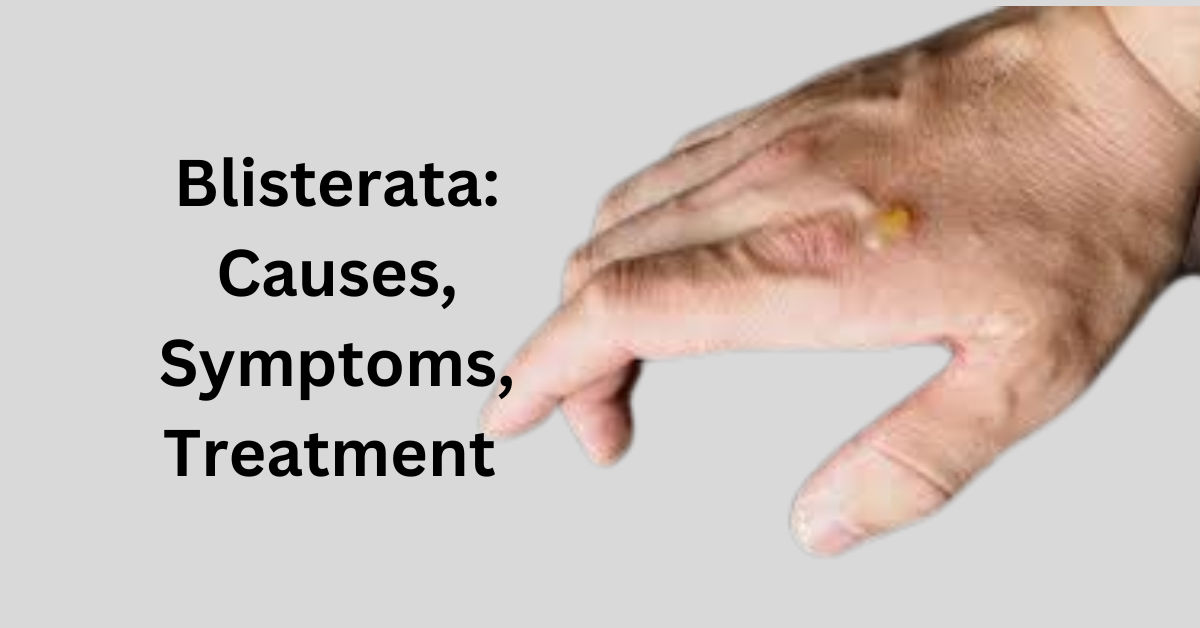 Blisterata Causes, Symptoms, Treatment